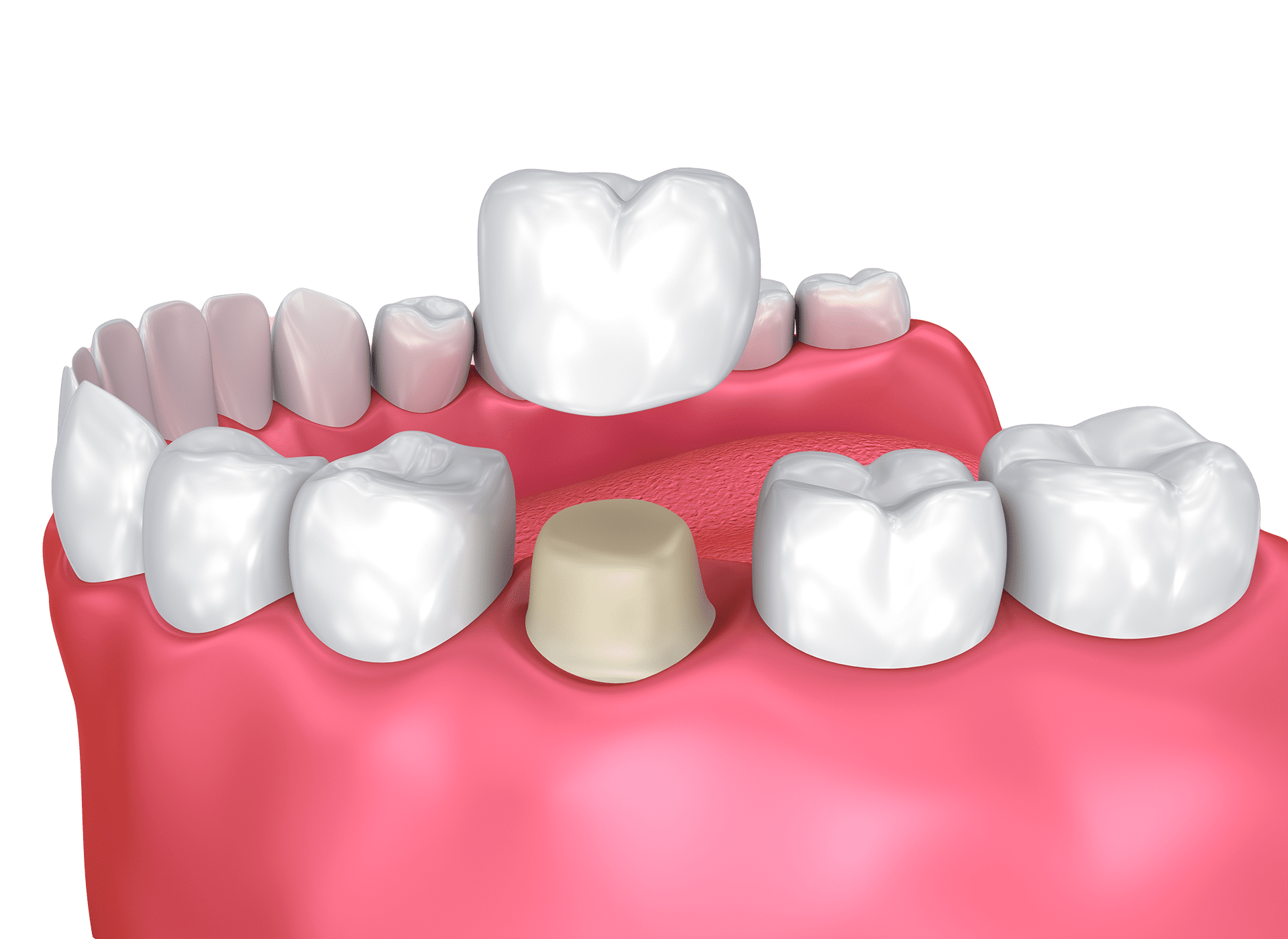 Tooth Crowns offered in Lenox Village